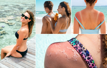 Comment un coup de soleil se développe-t-il et que faire en cas de coup de soleil ?